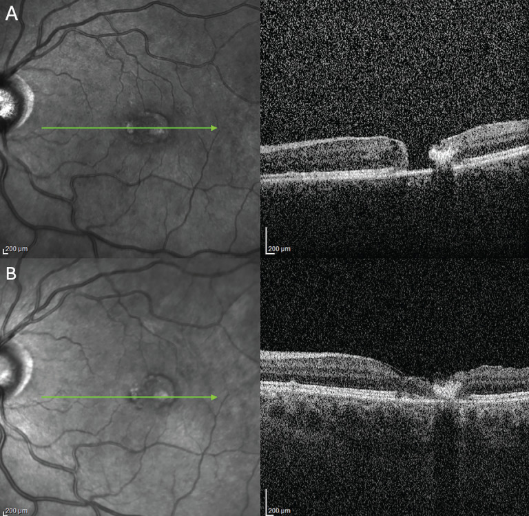 Macular Telangiectasia Type 2: Long-Term Disease Progression and Management of Complications.