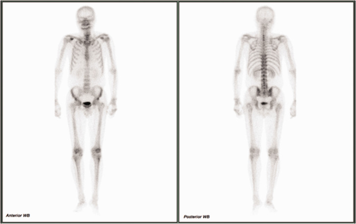 Misdiagnosis of supraclavicular brachial plexus metastasis as cervical disc herniation: A lung cancer case report.