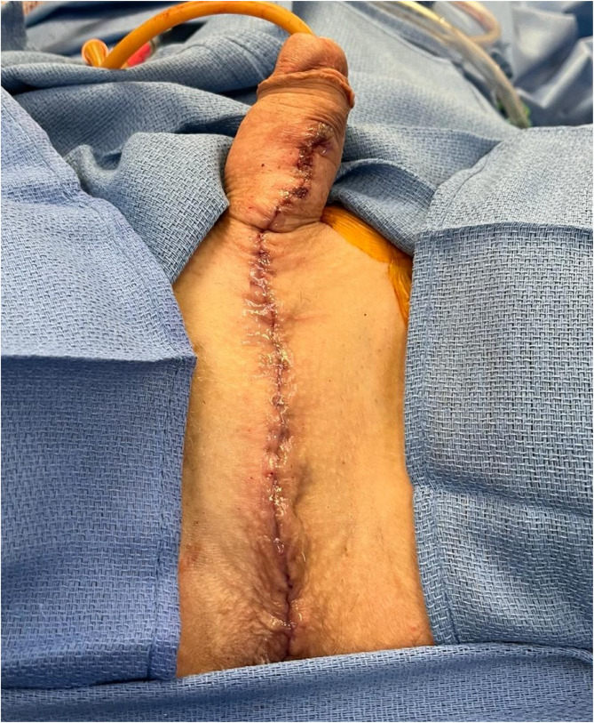 Orchiectomy and scrotectomy as genital gender-affirming surgery: novel surgical technique and patient-reported outcomes.