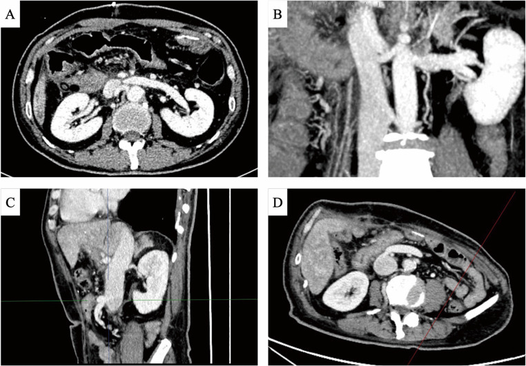 How-I-do-it: meso-caval shunt: a safe emergency option for venous reconstruction in pancreaticoduodenectomy.