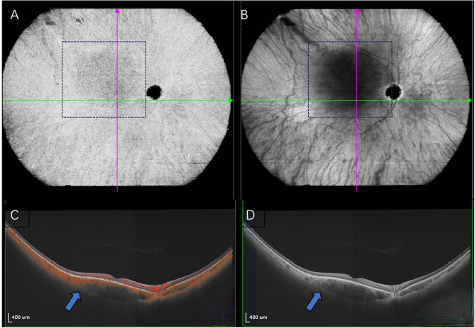 Choroidal hemangioma in Sturge-Weber syndrome elucidated by ultra-widefield swept-source optical coherence tomography angiography.