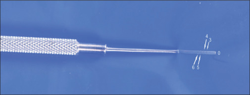 The "3-6 spatula": Customizing intraocular measurements.