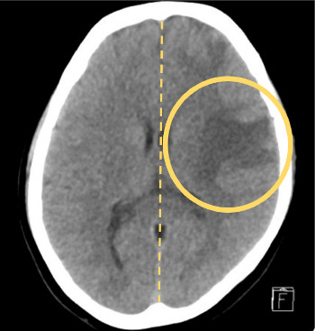 Beyond the Lungs: A Rare Case of Extrapulmonary Tuberculosis Presenting With Neck Vein Thrombosis and Seizure.