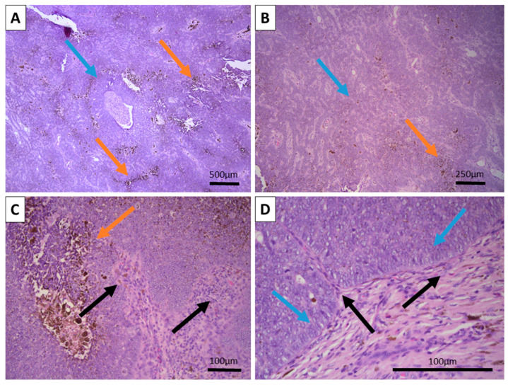Melanotrichoblastoma: A Histopathological Case Report of a Rare Pigmented Variant of Trichoblastoma.