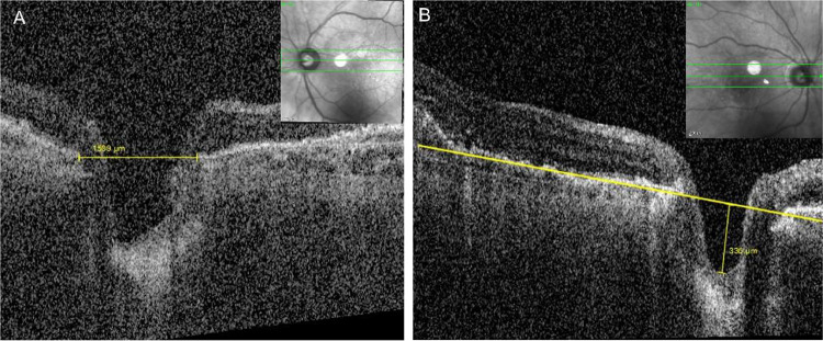 Optic Nerve Head Structural Changes After Intravitreal Injection.