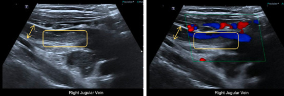 Beyond the Lungs: A Rare Case of Extrapulmonary Tuberculosis Presenting With Neck Vein Thrombosis and Seizure.