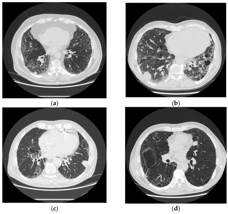 Concomitant Idiopathic Pulmonary Fibrosis and Lung Cancer: An Updated Narrative Review.