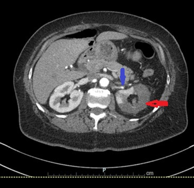 Transient Renal Artery Stenosis in Renal Infarction: A Case Report.