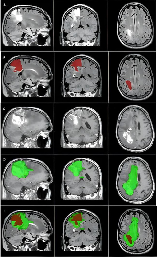 Correction: Preoperative FLAIR images for identifying glioblastoma boundaries.