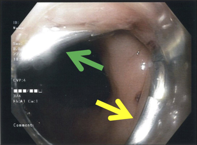 Endoscopic Treatment of a Colovesical Fistula Using a Through-The-Scope Clip Designed for Large Defect Closure.