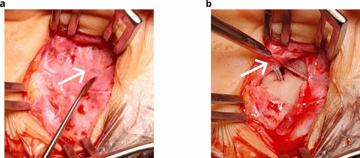 Impedance-based detection of cochlear implant array migration: case report in a child with Aymé-Gripp syndrome.