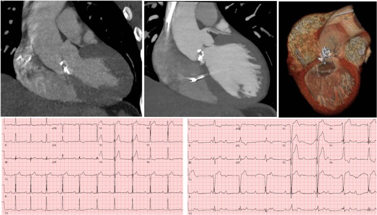 Case report: rapid progression of conduction system disturbance in unicuspid aortic valve stenosis.