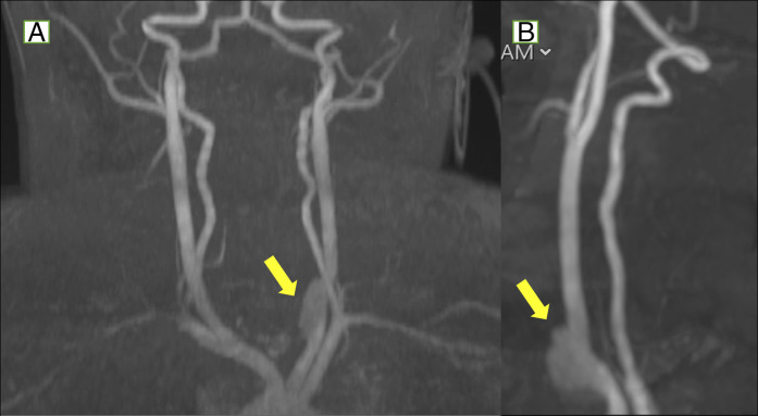 Management of a Pseudoaneurysm After Carotid-Esophageal Fistula Repair Secondary to Button Battery Ingestion in an Infant.