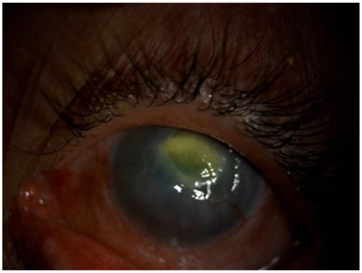 Methamphetamine-Associated Corneal Ulcer: Case Report.