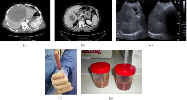 Amoebic Liver Abscesses in Returning Travelers: Lessons to Keep in Mind From a Nonendemic Area.