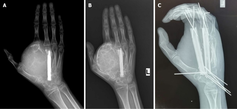 Rethinking the role of bisphosphonates after denosumab treatment in locally advanced or unresectable aneurysmal bone cysts: A meta-analysis.