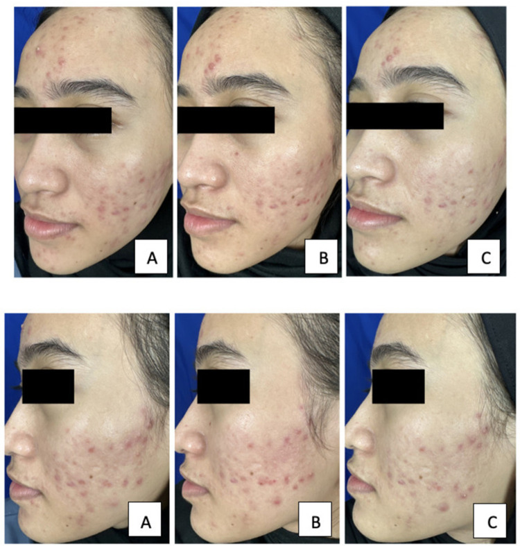 The Comparable Efficacy Between Tranexamic Acid Intradermal Injection and Pulsed Dye Laser for Treatment of Post-Acne Erythema: A Split-Face Therapy.