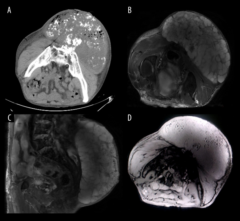 Diagnosis and Management of Large Extraosseous Myxoid Chondrosarcoma of the Buttocks: A Case Report.