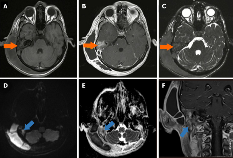 Role of imaging in chronic otitis media and its complications.