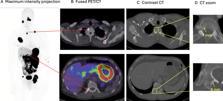 Novel radiopharmaceuticals for molecular imaging of renal cell carcinoma.