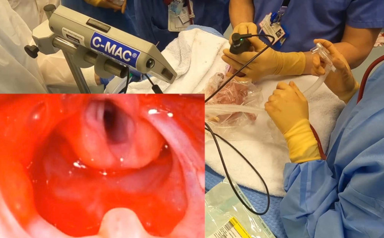 Video analysis of neonatal intubations using video laryngoscopy: a prospective comparison of clinical practice with resuscitation guidelines.