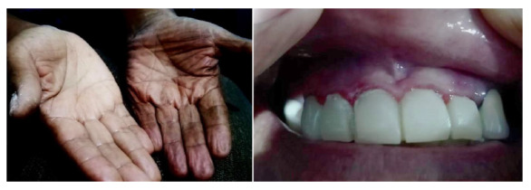 Addison's disease due to adrenal insufficiency in an immunocompetent patient with disseminated cryptococcosis. Case report.