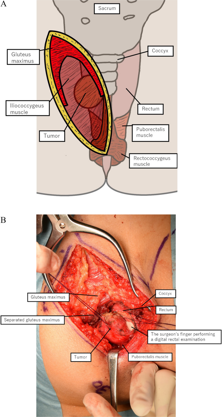 Partial resection of rectum for rectal GIST by posterior approach.