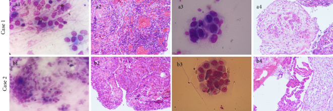 Cryobiopsy as a Salvage Technique Following Negative Flexible Forceps Biopsy of the Pleura Under Rapid On-Site Evaluation Guidance: A Prospective Study.