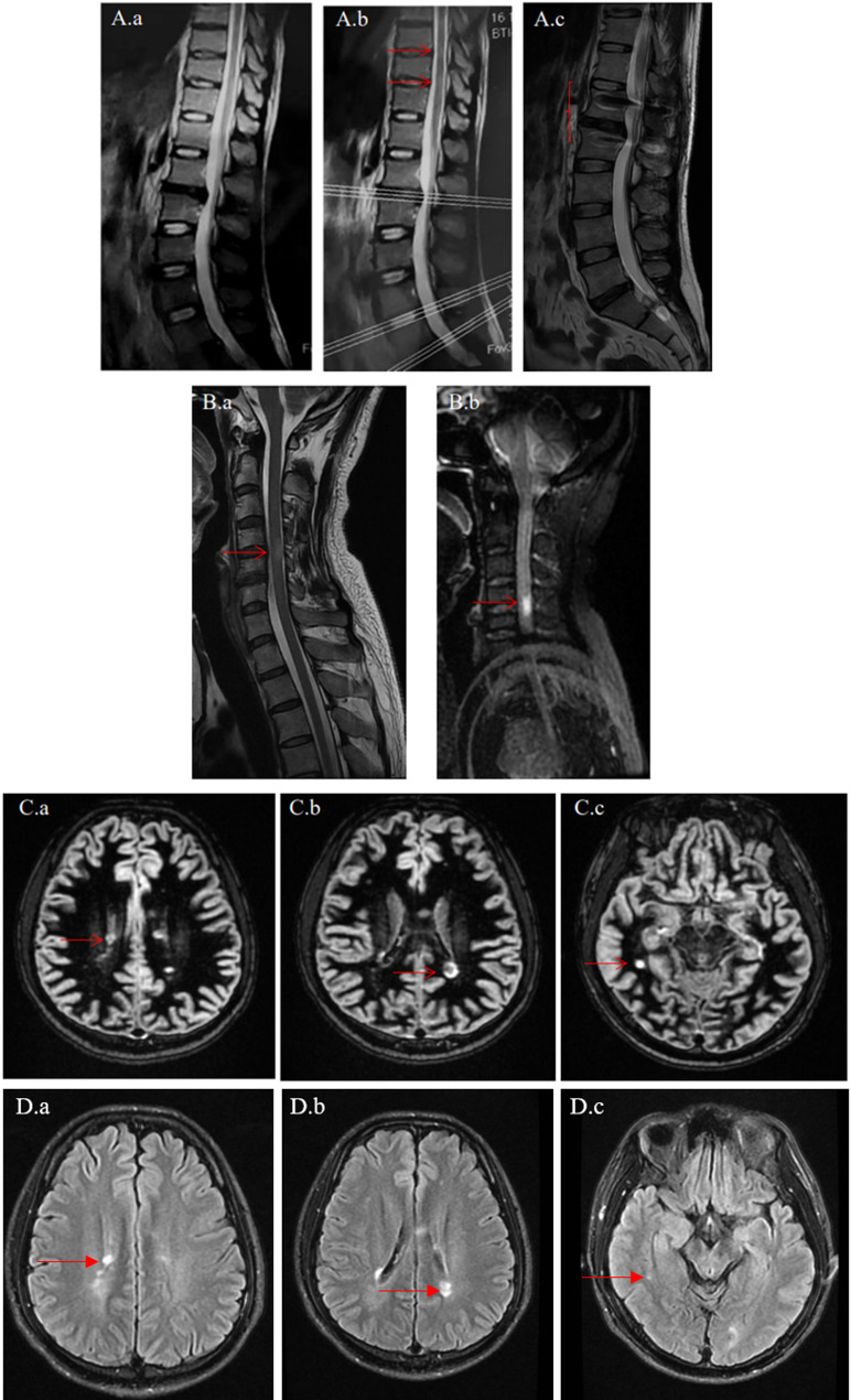Use of MRI-double inversion recovery sequence for early diagnosis of multiple sclerosis: case series.