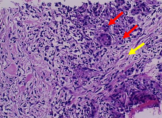 Pancreatic Inflammation Induced by Immune Checkpoint Inhibitors in Melanoma Treatment: A Case Report.