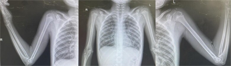 Precocious puberty in a rural Guatemalan boy: Unraveling the role of malnutrition and psychosocial stress.