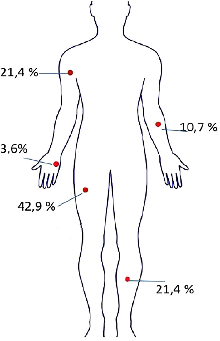 Wound infection and pain one month after trauma: an underestimated threat.