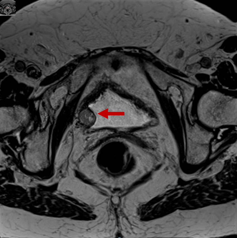 An Unusual Entity in Urology: Urinary Bladder Paraganglioma.