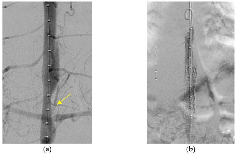 A Rare Case of Aortic Dissection 10 Years Post Percutaneous Catheterization Retrieval of an Embolized PDA Device in a Patient with Down Syndrome.