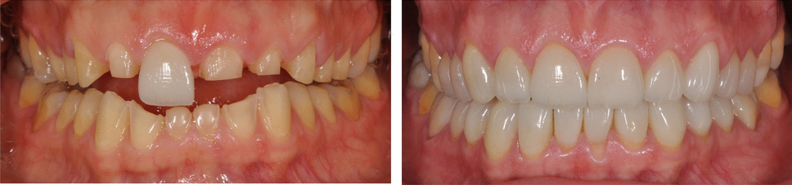 The journey to recovery: unmet dental care needs in individuals with eating disorders.