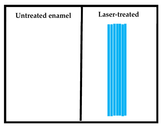 Microscopic and Crystallographic Analysis of Increased Acid Resistance of Melted Dental Enamel Using 445 nm Diode Laser: An Ex-Vivo Study.