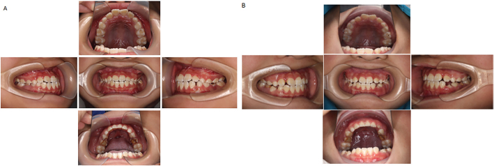 The three-dimensional influence and clinical significance of anterior traction with rapid expansion during dental replacement.
