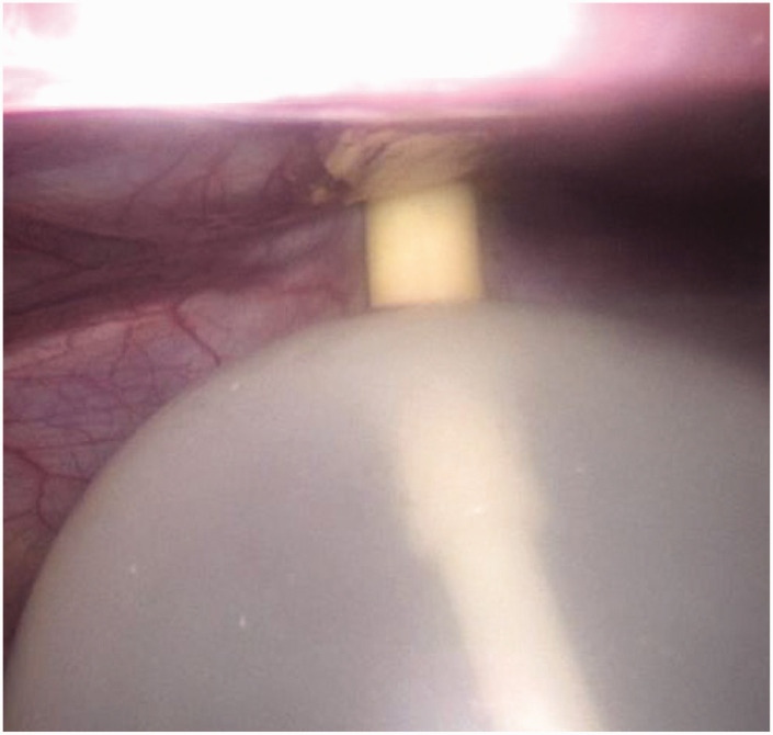 The balloon technique for trocar-site closure: Description of a novel technique along with a literature review.