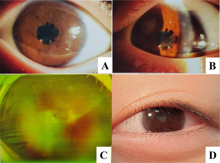 Clinical Characteristics and Prognosis of Juvenile Idiopathic Arthritis-Associated Uveitis: A Single-Center Retrospective Study.