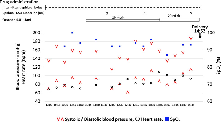 Posterior reversible encephalopathy syndrome during epidural labor analgesia: a case report.