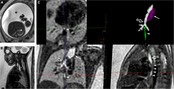 Enhanced fetal MRI diagnosis of esophageal atresia using super-resolution slice-to-volume reconstruction.