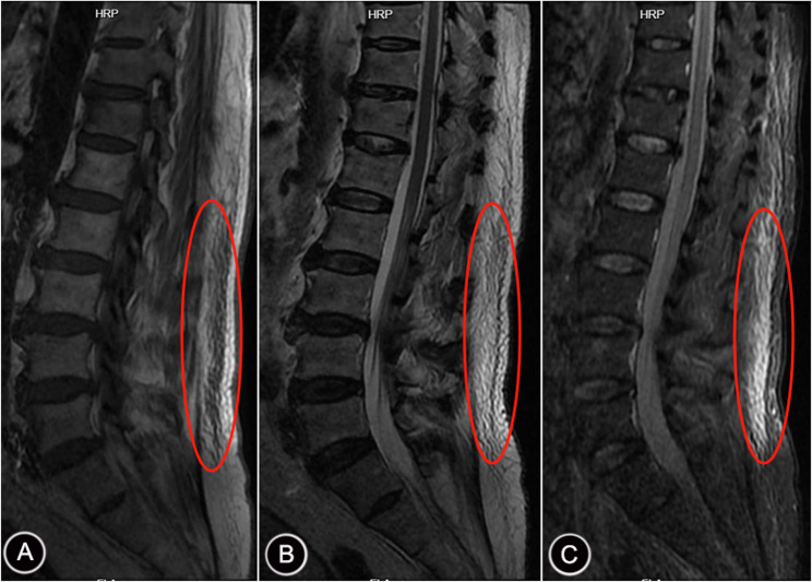 Risk factors of thoracolumbar fascia injury for patients with Parkinson's disease and construction of a nomogram model.