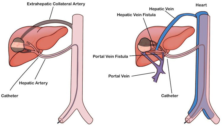 A Novel Quadruple Conversion Therapy: Converting Initially Unresectable Hepatocellular Carcinoma to Resectable with pTAE-HAIC, Tyrosine Kinase Inhibitors, and Anti-PD-1 Antibodies.