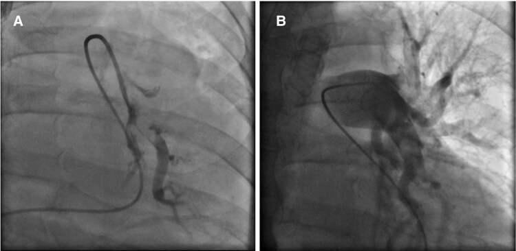 In-hospital cardiac arrest due to acute pulmonary embolism: a case report of successful catheter-directed thrombectomy on a patient with VA-ECMO.