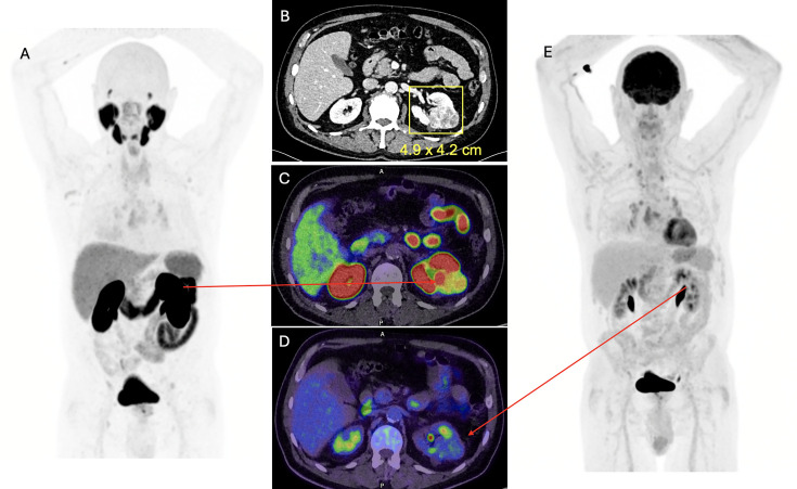 Novel radiopharmaceuticals for molecular imaging of renal cell carcinoma.