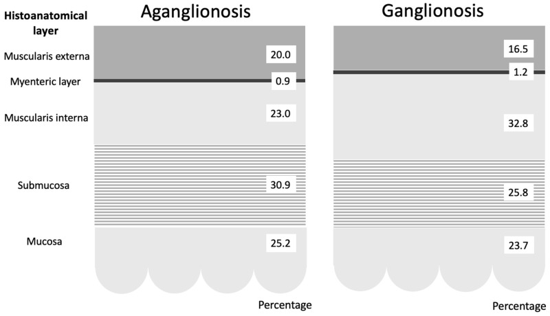 Histoanatomic Features Distinguishing Aganglionosis in Hirschsprung's Disease: Toward a Diagnostic Algorithm.