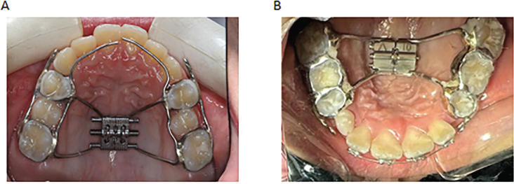 The three-dimensional influence and clinical significance of anterior traction with rapid expansion during dental replacement.