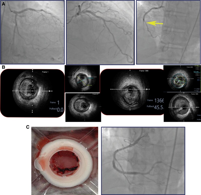 Concurrent inferior stemi with third-degree AV block and acute intracranial haemorrhage: how we overcame this clinical challenge-a case report.