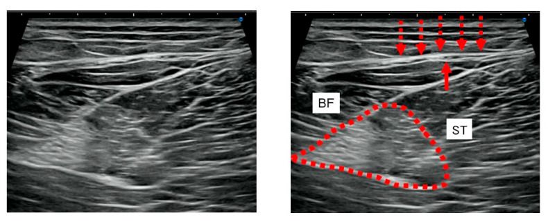 Ultrasound-Guided Fascial Hydrorelease for Persistent Pain After Hamstring Injury.