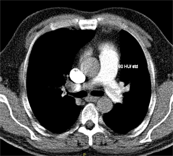 Atypical presentation of Merkel cell carcinoma with pulmonary embolism.